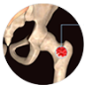 Multiple Myeloma