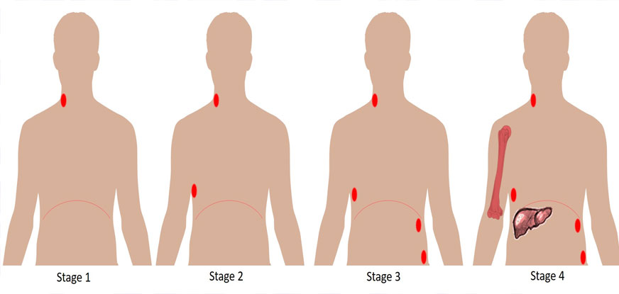 Lymphoma cancer treatment in lucknow