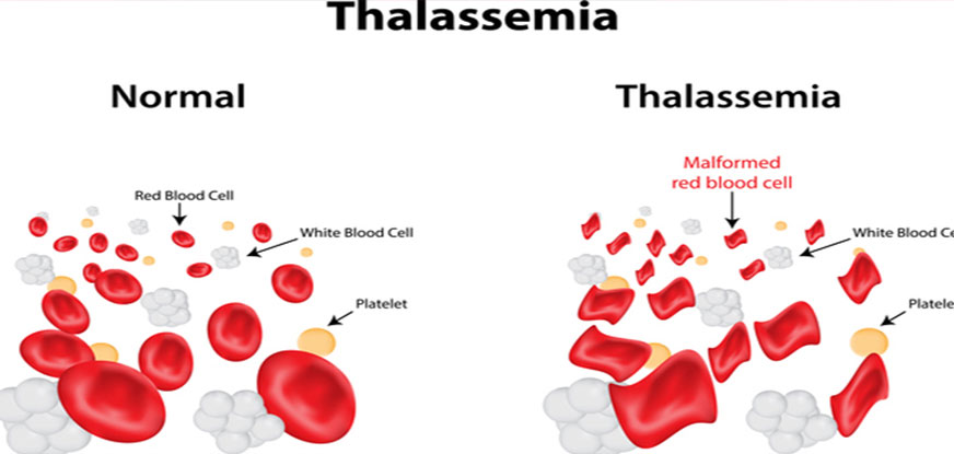 Thalassemia Treatment in Lucknow