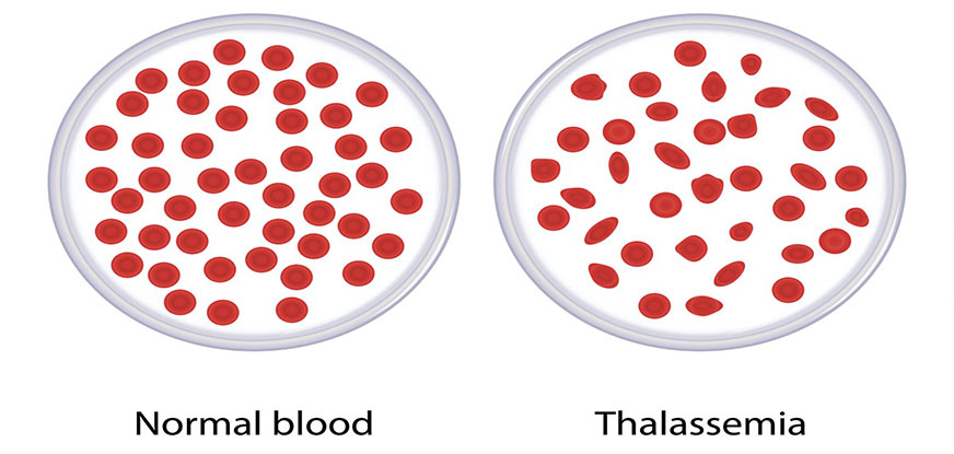 Thalassemia treatment